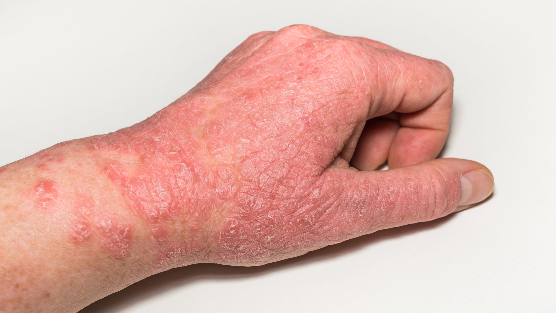 Inflamed, cracked eczema flare on the back of a hand