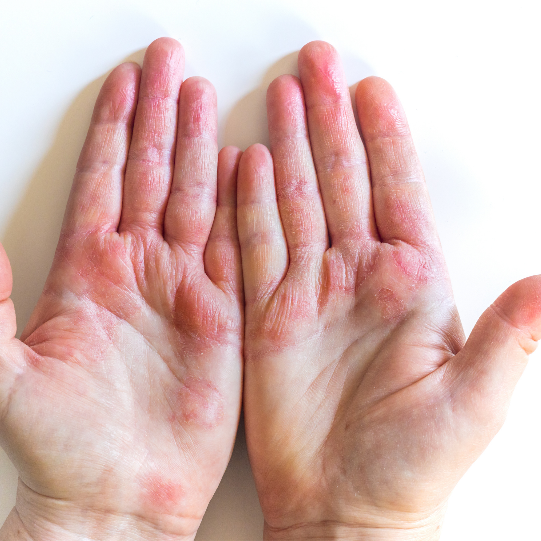 Inflamed, cracked eczema flare on the palms